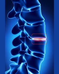 The Truth About Disc Degeneration and Chronic Lower Back Pain