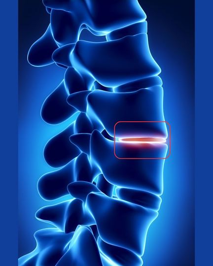 Why Lumbar Disc Degeneration Is Not the Cause of Your Back Pain