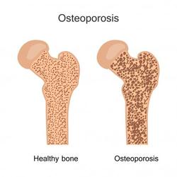 Osteoporosis Treatment and Prevention
