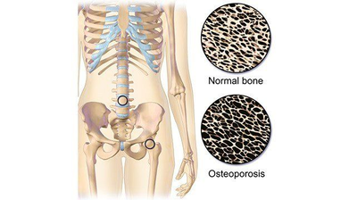 Osteoporosis and Yoga