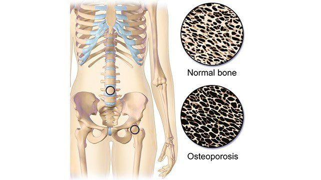 1149-osteoporosis-642×361-slide1