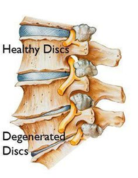 Living with Series: Degenerative Disc Disease