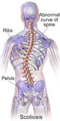 Living with Series: Scoliosis