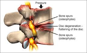lumbar stenosis