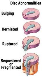 bulging disc
